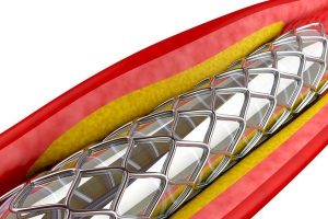Image of E&L testing on angioplasty medical device. Jordi Labs specializes in Extractables & Leachables (E&L) testing for medical devices.
